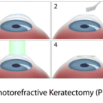 Eye Surgery