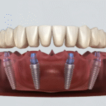 How Implant And Cosmetic Dentistry Work Together For Full Smile Transformations