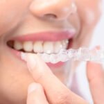 4 Common Cosmetic Dental Treatments Explained Simply