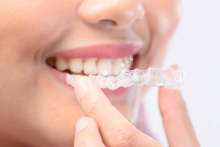 4 Common Cosmetic Dental Treatments Explained Simply
